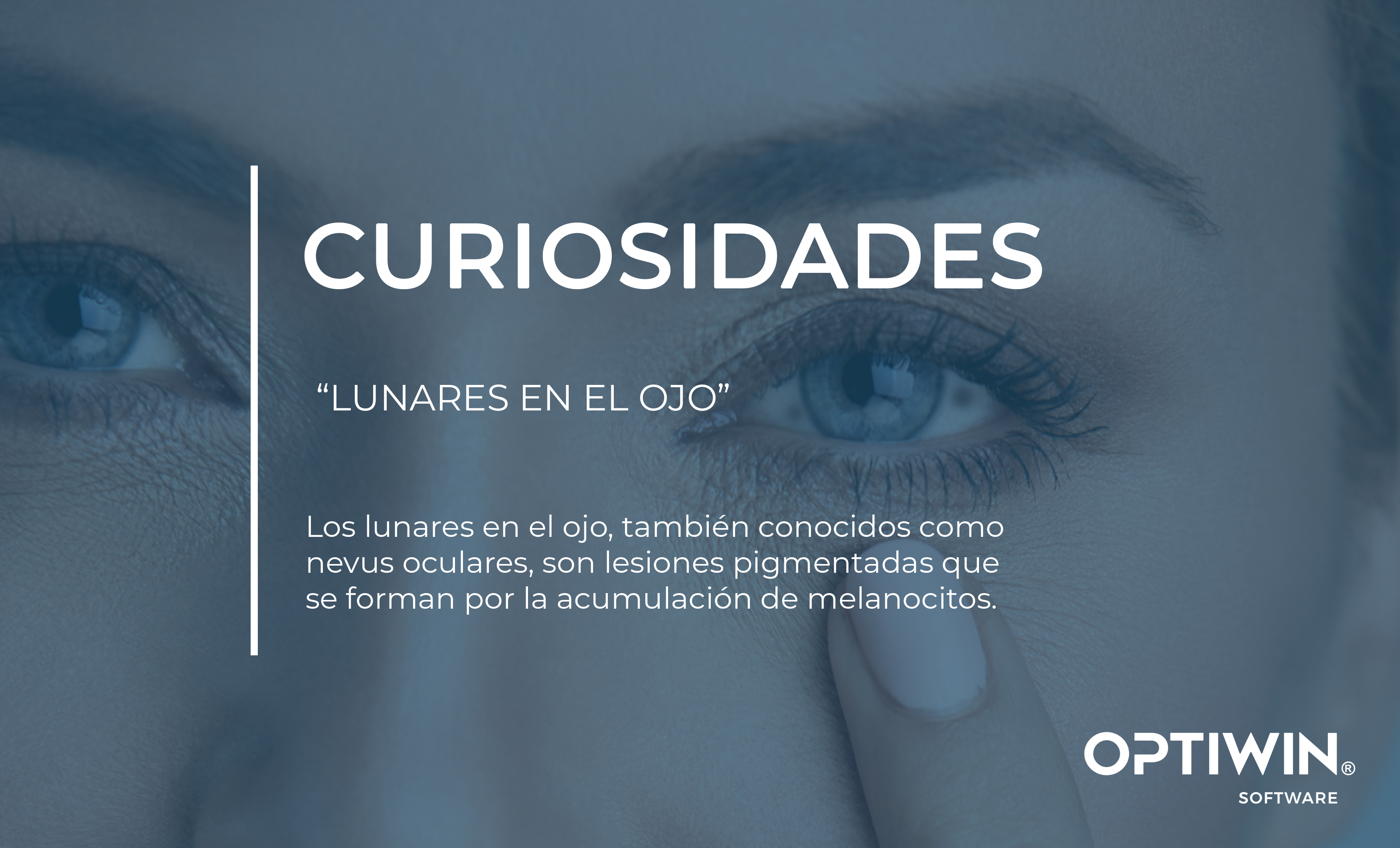 LUNARES EN EL OJO:¿QUÉ SON LOS LUNARES EN EL OJO Y POR QUÉ DEBES VIGILARLOS?